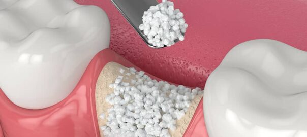 bone grafting in Delhi