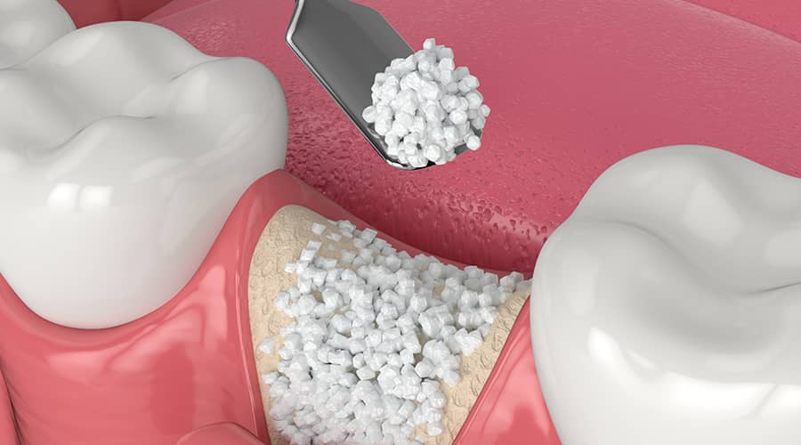 bone grafting in Delhi